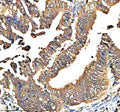 Immunohistochemical staining of QRSL1 using anti-QRSL1 antibody. QRSL1 was detected in a paraffin-embedded section of human thyroid cancer tissue. Heat mediated antigen retrieval was performed in EDTA buffer (pH 8.0, epitope retrieval solution). The tissue section was blocked with 10% goat serum. The tissue section was then incubated with 2 ug/ml rabbit anti-QRSL1 antibody overnight at 4oC. Peroxidase Conjugated Goat Anti-rabbit IgG was used as secondary antibody and incubated for 30 min at 37oC.