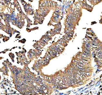 Immunohistochemical staining of QRSL1 using anti-QRSL1 antibody. QRSL1 was detected in a paraffin-embedded section of human thyroid cancer tissue. Heat mediated antigen retrieval was performed in EDTA buffer (pH 8.0, epitope retrieval solution). The tissue section was blocked with 10% goat serum. The tissue section was then incubated with 2 ug/ml rabbit anti-QRSL1 antibody overnight at 4oC. Peroxidase Conjugated Goat Anti-rabbit IgG was used as secondary antibody and incubated for 30 min at 37oC.