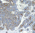 IHC staining of FFPE human parotid acinar cell carcinoma tissue with Alkaline Phosphatase antibody. HIER: boil tissue sections in pH8 EDTA for 20 min and allow to cool before testing.