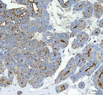 IHC staining of FFPE human parotid acinar cell carcinoma tissue with Alkaline Phosphatase antibody. HIER: boil tissue sections in pH8 EDTA for 20 min and allow to cool before testing.