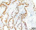 IHC staining of human lung adenocarcinoma (10X) with TTF-1 antibody (8G7G3/1).