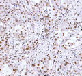 IHC staining of FFPE human lung cancer tissue with ARID domain-containing protein 1A antibody. HIER: boil tissue sections in pH8 EDTA for 20 min and allow to cool before testing.