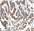 IHC staining of FFPE human lung cancer tissue with SHP2 antibody, HRP-secondary and DAB substrate. HIER: boil tissue sections in pH8 EDTA for 20 min and allow to cool before testing.