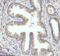 Immunohistochemical staining of PIPOX using anti-PIPOX antibody. PIPOX was detected in a paraffin-embedded section of human prostate cancer tissue. Heat mediated antigen retrieval was performed in EDTA buffer (pH 8.0, epitope retrieval solution). The tissue section was blocked with 10% goat serum. The tissue section was then incubated with 2 ug/ml rabbit anti-PIPOX antibody overnight at 4oC. Peroxidase Conjugated Goat Anti-rabbit IgG was used as secondary antibody and incubated for 30 min at 37oC.