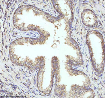 Immunohistochemical staining of PIPOX using anti-PIPOX antibody. PIPOX was detected in a paraffin-embedded section of human prostate cancer tissue. Heat mediated antigen retrieval was performed in EDTA buffer (pH 8.0, epitope retrieval solution). The tissue section was blocked with 10% goat serum. The tissue section was then incubated with 2 ug/ml rabbit anti-PIPOX antibody overnight at 4oC. Peroxidase Conjugated Goat Anti-rabbit IgG was used as secondary antibody and incubated for 30 min at 37oC.