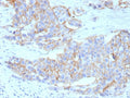 IHC staining of FFPE human breast cancer tissue with recombinant HER-2 antibody (clone ERBB2/13055R). Inset: PBS used in place of primary Ab (secondary Ab negative control). HIER: boil tissue sections in pH 9 10mM Tris with 1mM EDTA for 20 min and allow to cool before testing.
