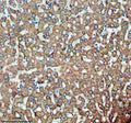 Immunohistochemical staining of TIRAP using anti-TIRAP antibody. TIRAP was detected in a paraffin-embedded section of human liver cancer tissue. Heat mediated antigen retrieval was performed in EDTA buffer (pH 8.0, epitope retrieval solution). The tissue section was blocked with 10% goat serum. The tissue section was then incubated with 2 ug/ml rabbit anti-TIRAP antibody overnight at 4oC. Peroxidase Conjugated Goat Anti-rabbit IgG was used as secondary antibody and incubated for 30 min at 37oC.