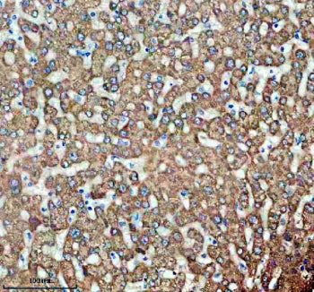 Immunohistochemical staining of TIRAP using anti-TIRAP antibody. TIRAP was detected in a paraffin-embedded section of human liver cancer tissue. Heat mediated antigen retrieval was performed in EDTA buffer (pH 8.0, epitope retrieval solution). The tissue section was blocked with 10% goat serum. The tissue section was then incubated with 2 ug/ml rabbit anti-TIRAP antibody overnight at 4oC. Peroxidase Conjugated Goat Anti-rabbit IgG was used as secondary antibody and incubated for 30 min at 37oC.