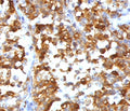 IHC testing of formalin-fixed, paraffin-embedded human melanoma stained with recombinant MART-1 antibody (clone RMMRT1-1). HIER: steam sections in pH 9 10mM Tris with 1mM EDTA for 10-20 min.