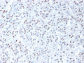 IHC testing of FFPE human mesothelioma with Wilms Tumor 1 antibody (clone 6F-H2). Required HIER: boil tissue sections in pH 9 10mM Tris with 1mM EDTA for 10-20 min followed by cooling at RT for 20 min.