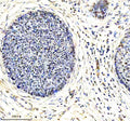Immunohistochemical staining of using anti-ARL2 antibody. was detected in a paraffin-embedded section of human cervical cancer tissue. Heat mediated antigen retrieval was performed in EDTA buffer (pH 8.0, epitope retrieval solution). The tissue section was blocked with 10% goat serum. The tissue section was then incubated with 2 ug/ml rabbit anti-ARL2 antibody overnight at 4oC. Peroxidase Conjugated Goat Anti-rabbit IgG was used as secondary antibody and incubated for 30 min at 37oC.