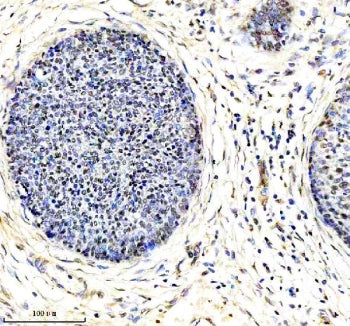 Immunohistochemical staining of using anti-ARL2 antibody. was detected in a paraffin-embedded section of human cervical cancer tissue. Heat mediated antigen retrieval was performed in EDTA buffer (pH 8.0, epitope retrieval solution). The tissue section was blocked with 10% goat serum. The tissue section was then incubated with 2 ug/ml rabbit anti-ARL2 antibody overnight at 4oC. Peroxidase Conjugated Goat Anti-rabbit IgG was used as secondary antibody and incubated for 30 min at 37oC.