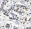IHC staining of FFPE human stomach cancer tissue with PHF8 antibody, HRP-secondary and DAB substrate. HIER: boil tissue sections in pH8 EDTA for 20 min and allow to cool before testing.