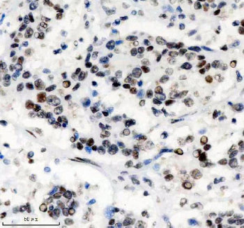 IHC staining of FFPE human stomach cancer tissue with PHF8 antibody, HRP-secondary and DAB substrate. HIER: boil tissue sections in pH8 EDTA for 20 min and allow to cool before testing.