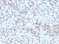 IHC: Formalin-fixed, paraffin-embedded human hepatocellular carcinoma stained with recombinant RBP-1 (clone rRBP/872). HIER: boil tissue sections in pH 9 10mM Tris with 1mM EDTA for 20 min and allow to cool before testing.