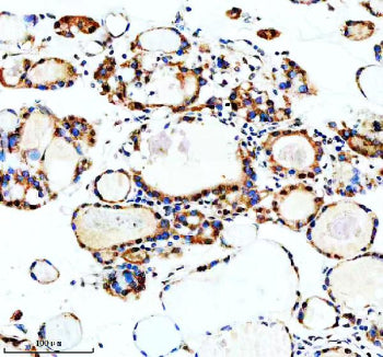 Immunohistochemical staining of MSI2 using anti-MSI2 antibody. MSI2 was detected in a paraffin-embedded section of human thyroid cancer tissue. Heat mediated antigen retrieval was performed in EDTA buffer (pH 8.0, epitope retrieval solution). The tissue section was blocked with 10% goat serum. The tissue section was then incubated with 2 ug/ml rabbit anti-MSI2 antibody overnight at 4oC. Peroxidase Conjugated Goat Anti-rabbit IgG was used as secondary antibody and incubated for 30 min at 37oC.