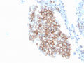 IHC staining of FFPE human lung carcinoma with CD86 antibody (clone C86/3716). HIER: boil tissue sections in pH 9 10mM Tris with 1mM EDTA for 20 min and allow to cool before testing.