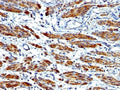 IHC: Formalin-fixed, paraffin-embedded human Leiomyosarcoma stained with SMMHC antibody (MYH11/923 + SMMS-1).