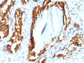 IHC testing of human prostate carcinoma with recombinant PSAP antibody (clone rACPP/1338). Required HIER: boil tissue sections in 10mM citrate buffer, pH 6, for 10-20 min followed by cooling at RT for 20 min.