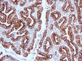 IHC testing of FFPE human gastric carcinoma with MUC5AC antibody (clone CLH2). Required HIER: steam section in pH 9 10mM Tris with 1mM EDTA for 20 min and allow to cool prior to testing.