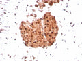IHC staining of FFPE human sarcoma tissue with INI-1 antibody (clone SMARCB1/8851R) HIER: boil tissue sections in pH 9 10mM Tris with 1mM EDTA for 20 min and allow to cool before testing.
