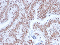 IHC staining of FFPE human colon carcinoma with NRF1 antibody. HIER: boil tissue sections in pH 9 10mM Tris with 1mM EDTA for 20 min and allow to cool before testing.