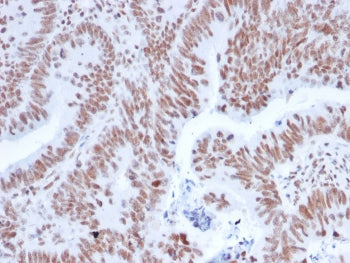 IHC staining of FFPE human colon carcinoma with NRF1 antibody. HIER: boil tissue sections in pH 9 10mM Tris with 1mM EDTA for 20 min and allow to cool before testing.