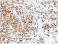 IHC staining of FFPE human melanoma tissue with recombinant PMEL17 antibody (clone rPMEL17/6821). HIER: boil tissue sections in pH 9 10mM Tris with 1mM EDTA for 20 min and allow to cool before testing.