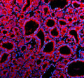 Immunofluorescent staining of Teneurin 1/TENM1 using anti-TENM1 antibody (red). Teneurin 1/TENM1 was detected in a paraffin-embedded section of human thyroid cancer tissue. Heat mediated antigen retrieval was performed in EDTA buffer (pH 8.0, epitope retrieval solution). The tissue section was blocked with 10% goat serum. The tissue section was then incubated with 5 ug/ml rabbit anti-TENM1 antibody overnight at 4oC.