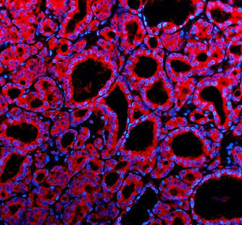Immunofluorescent staining of Teneurin 1/TENM1 using anti-TENM1 antibody (red). Teneurin 1/TENM1 was detected in a paraffin-embedded section of human thyroid cancer tissue. Heat mediated antigen retrieval was performed in EDTA buffer (pH 8.0, epitope retrieval solution). The tissue section was blocked with 10% goat serum. The tissue section was then incubated with 5 ug/ml rabbit anti-TENM1 antibody overnight at 4oC.