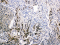 IHC testing of FFPE human intestinal cancer tissue with FABP2 antibody at 1ug/ml. Required HIER: steam section in pH6 citrate buffer for 20 min and allow to cool prior to testing.