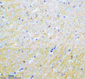 Immunohistochemical staining of MARCKS using anti-MARCKS antibody. MARCKS was detected in a paraffin-embedded section of human stomach cancer tissue. Heat mediated antigen retrieval was performed in EDTA buffer (pH 8.0, epitope retrieval solution). The tissue section was blocked with 10% goat serum. The tissue section was then incubated with 2 ug/ml rabbit anti-MARCKS antibody overnight at 4oC. Peroxidase Conjugated Goat Anti-rabbit IgG was used as secondary antibody and incubated for 30 min at 37oC.