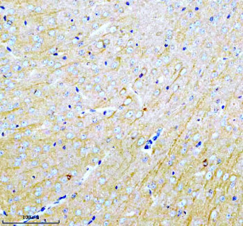 Immunohistochemical staining of MARCKS using anti-MARCKS antibody. MARCKS was detected in a paraffin-embedded section of human stomach cancer tissue. Heat mediated antigen retrieval was performed in EDTA buffer (pH 8.0, epitope retrieval solution). The tissue section was blocked with 10% goat serum. The tissue section was then incubated with 2 ug/ml rabbit anti-MARCKS antibody overnight at 4oC. Peroxidase Conjugated Goat Anti-rabbit IgG was used as secondary antibody and incubated for 30 min at 37oC.