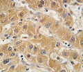 IHC analysis of FFPE human hepatocarcinoma tissue stained with APOA5 antibody.