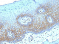 IHC testing of FFPE human cervical carcinoma with Thrombomodulin antibody (clone THBD/1782). HIER: boil tissue sections in 10mM Tris buffer with 1mM EDTA, pH 9, for 10-20 min followed by cooling at RT for 20 min.