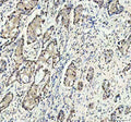 Immunohistochemical staining of RANBP3 using anti-RANBP3 antibody. RANBP3 was detected in a paraffin-embedded section of human breast cancer tissue. Heat mediated antigen retrieval was performed in EDTA buffer (pH 8.0, epitope retrieval solution). The tissue section was blocked with 10% goat serum. The tissue section was then incubated with 2 ug/ml rabbit anti-RANBP3 antibody overnight at 4oC. Peroxidase Conjugated Goat Anti-rabbit IgG was used as secondary antibody and incubated for 30 min at 37oC.