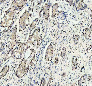 Immunohistochemical staining of RANBP3 using anti-RANBP3 antibody. RANBP3 was detected in a paraffin-embedded section of human breast cancer tissue. Heat mediated antigen retrieval was performed in EDTA buffer (pH 8.0, epitope retrieval solution). The tissue section was blocked with 10% goat serum. The tissue section was then incubated with 2 ug/ml rabbit anti-RANBP3 antibody overnight at 4oC. Peroxidase Conjugated Goat Anti-rabbit IgG was used as secondary antibody and incubated for 30 min at 37oC.