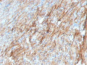 IHC staining of FFPE human lung with Fibronectin antibody (clone FN1/3029). HIER: boil tissue sections in pH 9 10mM Tris with 1mM EDTA for 20 min and allow to cool before testing.