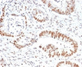 IHC staining of FFPE human colon tissue with MSH2 antibody (clone MSH2/6852). HIER: boil tissue sections in pH 9 10mM Tris with 1mM EDTA for 20 min and allow to cool before testing.