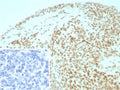 IHC staining of FFPE human ovarian cancer tissue with SMARCB1 antibody (clone INI1/8935R) Inset: PBS used in place of primary Ab (secondary Ab negative control). HIER: boil tissue sections in pH 9 10mM Tris with 1mM EDTA for 20 min and allow to cool before testing.