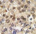 IHC analysis of FFPE human hepatocarcinoma tissue stained with RUNX2 antibody