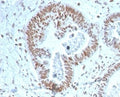IHC staining of FFPE human prostate carcinoma tissue with ZNF704 antibody (clone PCRP-ZNF704-3C10). HIER: boil tissue sections in pH 9 10mM Tris with 1mM EDTA for 20 min and allow to cool before testing.
