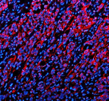Immunofluorescent staining of TWSG1 using anti-TWSG1 antibody (red). TWSG1 was detected in a paraffin-embedded section of human bladder cancer tissue. Heat mediated antigen retrieval was performed in EDTA buffer (pH 8.0, epitope retrieval solution). The tissue section was blocked with 10% goat serum. The tissue section was then incubated with 5 ug/ml rabbit anti-TWSG1 antibody overnight at 4oC.