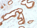 IHC testing of FFPE human renal cell carcinoma with recombinant AMACR antibody. Required HIER: steam section in pH6 citrate buffer for 20 min and allow to cool prior to staining.