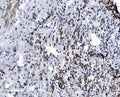 IHC staining of FFPE human breast cancer with VDAC3 antibody. HIER: boil tissue sections in pH8 EDTA for 20 min and allow to cool before testing.