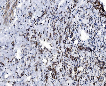 IHC staining of FFPE human breast cancer with VDAC3 antibody. HIER: boil tissue sections in pH8 EDTA for 20 min and allow to cool before testing.