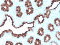 IHC staining of FFPE human breast carcinoma with recombinant pS2 antibody (clone rTFF1/1091). HIER: boil tissue sections in pH 9 10mM Tris with 1mM EDTA for 20 min and allow to cool before testing.
