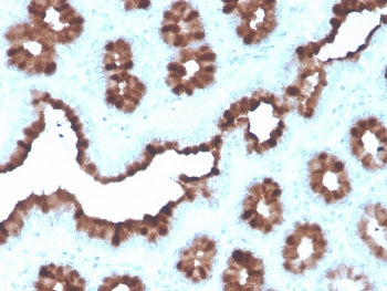 IHC staining of FFPE human breast carcinoma with recombinant pS2 antibody (clone rTFF1/1091). HIER: boil tissue sections in pH 9 10mM Tris with 1mM EDTA for 20 min and allow to cool before testing.