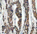 IHC staining of FFPE human breast cancer tissue with IkB beta antibody, HRP-secondary and DAB substrate. HIER: boil tissue sections in pH8 EDTA for 20 min and allow to cool before testing.
