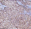 Immunohistochemical staining of RBM42 using anti-RBM42 antibody. RBM42 was detected in a paraffin-embedded section of human prostate adenocarcinoma tissue. Heat mediated antigen retrieval was performed in EDTA buffer (pH 8.0, epitope retrieval solution). The tissue section was blocked with 10% goat serum. The tissue section was then incubated with 2 ug/ml rabbit anti-RBM42 antibody overnight at 4oC. Peroxidase Conjugated Goat Anti-rabbit IgG was used as secondary antibody and incubated for 30 min at 37oC.
